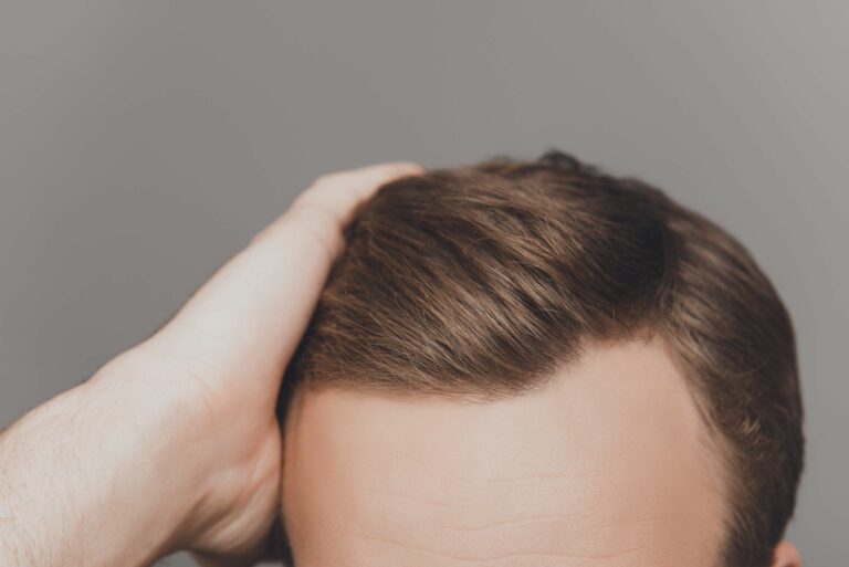 What causes balding?